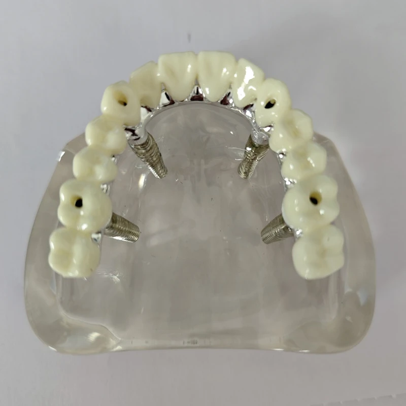 1pc Dental Implant Bridge Model Overdenture Restoration Upper Jaw Removable Teeth Model Dentisit Oral Teaching Research Tools
