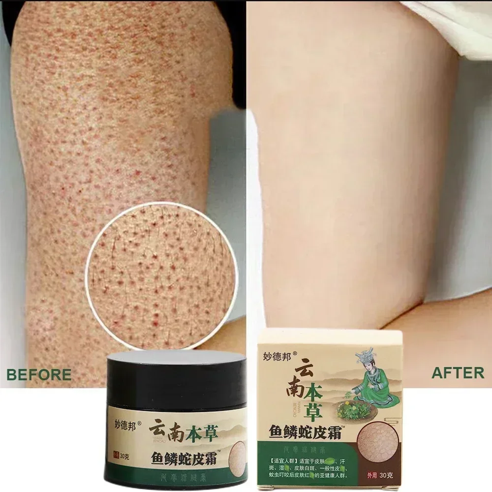 Curing Keratosis Pilaris Chicken Follicle Skin Repair Cream Body Dark Spot Remove Whiten Smooth Moisturize Skincare Body Lotion