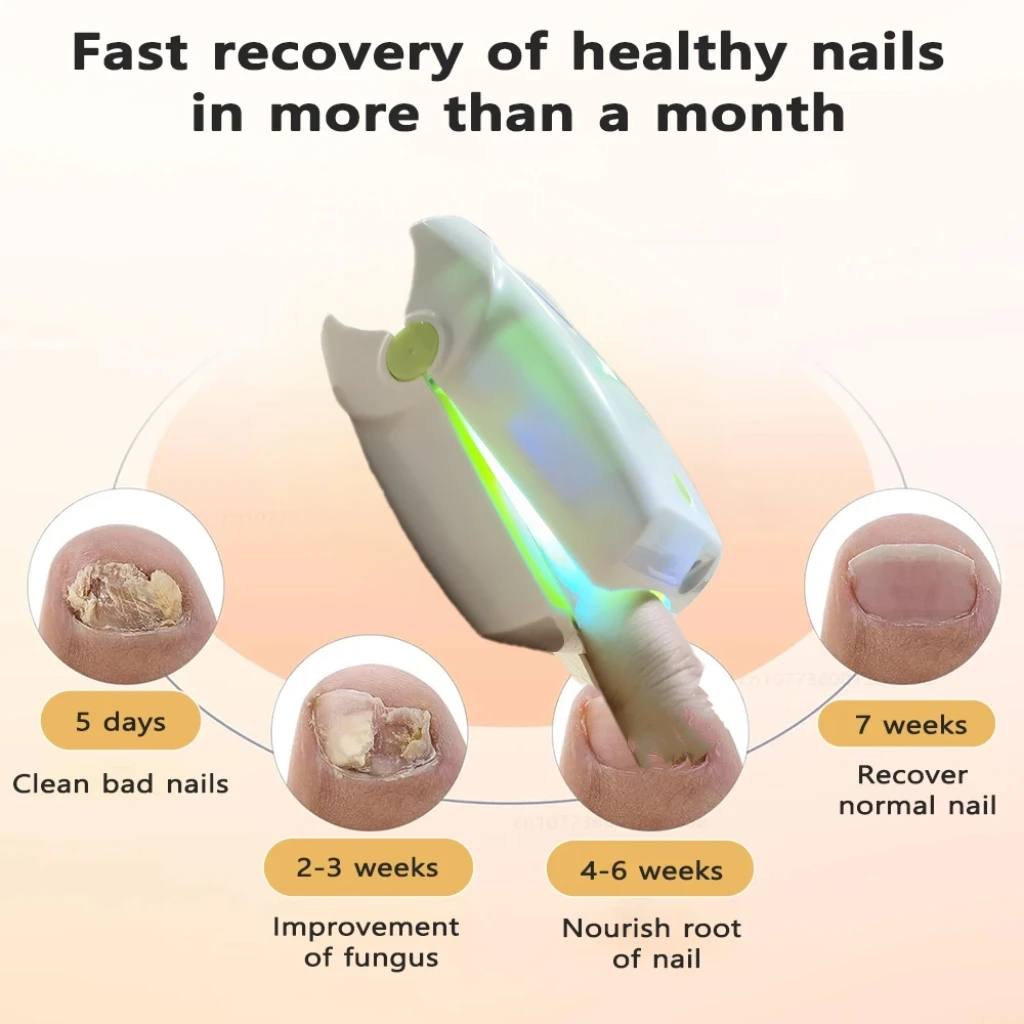 

905NM Nail Fungus Laser Nail Device USB Charging Light For Fingernails Toenails Onychomycosis Relieve Machine