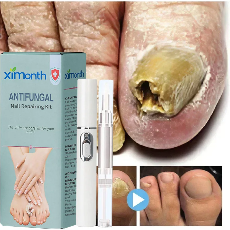 Stylo laser de soin des ongles, réparation rapide et efficace, UNIS issement des pieds N64.Outils de soin des pieds pour le traitement des champignons des ongles