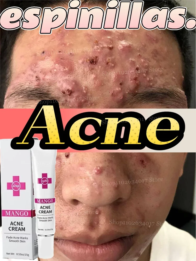 

Say goodbye to acne, natural herbal essence, deep clear acne, smooth skin. Essence