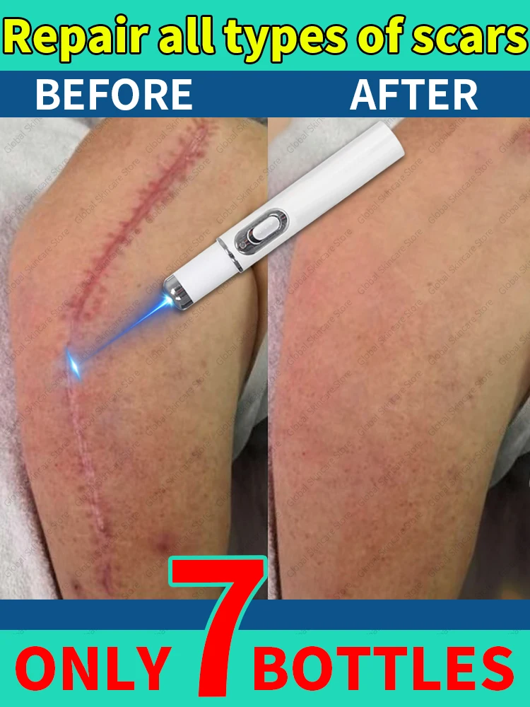 Laser rapid scar repair