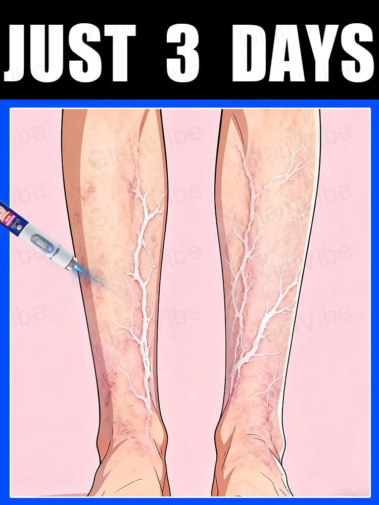 

Generation-2 Laser Says Goodbye To Spider Legs Varicose In 7 Days