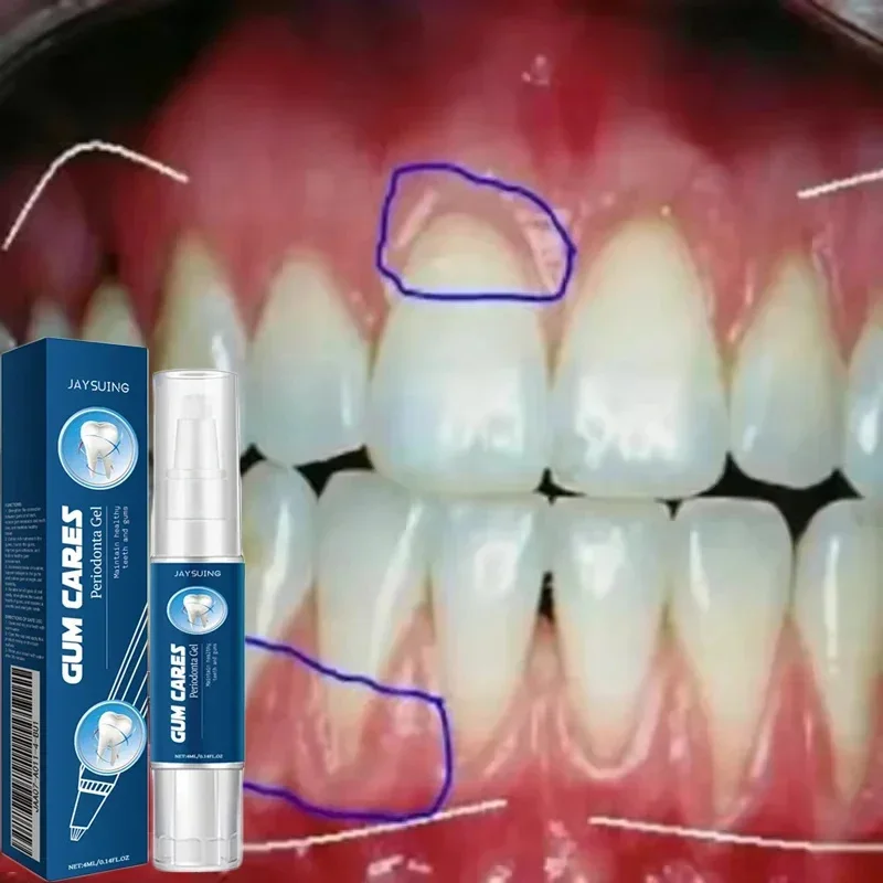 Beschädigtes Zahnfleisch-Reparatur-Pflegegel, lindert wundenes Zahnfleisch, Allergie, Tiefenreinigung, Zahnflecken, Zahnstein, Serum, Zahnkaries, Zahnpasta