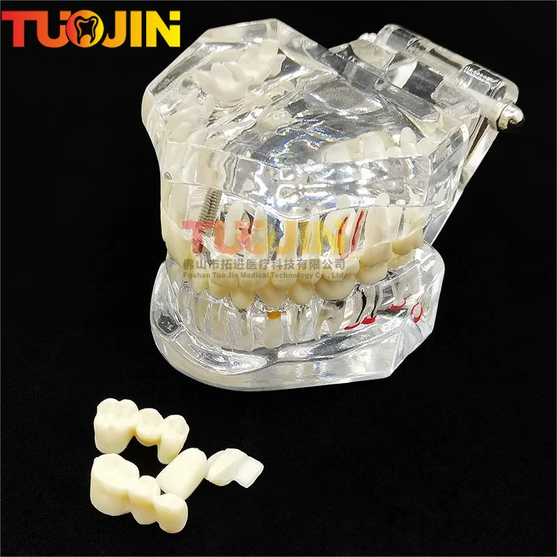 1pc Transparent Disease Teeth Model Dental Implant Teeth Model Dentist Dental Student Learning TeachingResearch Communication