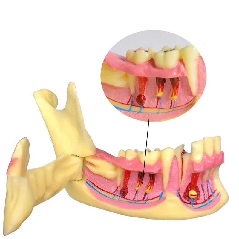 Dental M4014 Mandible Model Teeth Anatomy Tooth Model Showing Impaction Caries and Abscess for Teaching Study Dental clinic