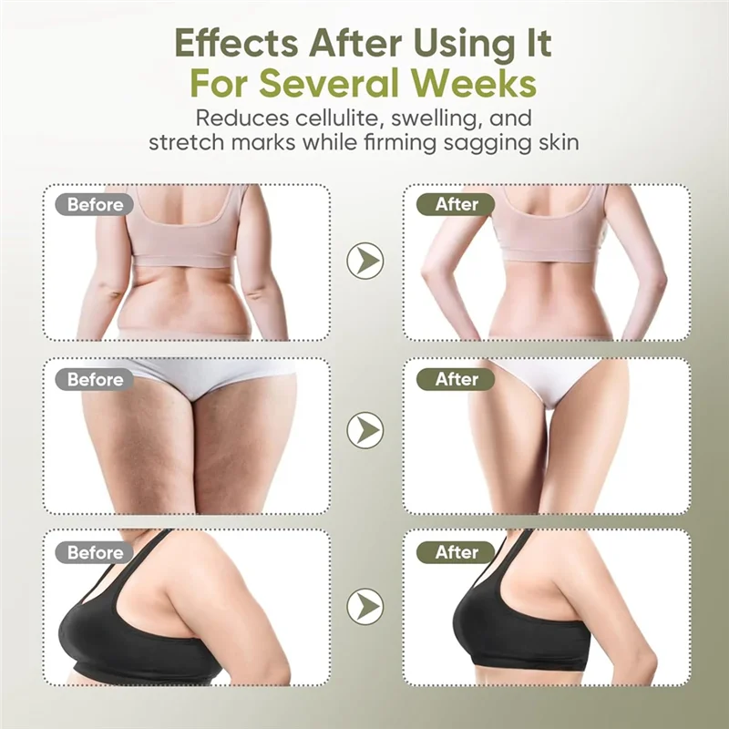 A01V-เครื่องนวดระบายน้ำเหลืองและเครื่องมือนวดต่อต้านเซลลูไลท์สำหรับขา แขน ร่างกาย ช่วยลดรอยแตกลายและเซลลูไลท์