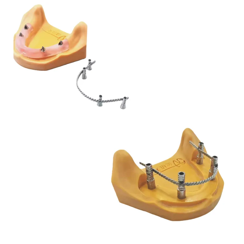 

3/5/10Pcs Dental Implant Connector Overdenture Strengthener MU Wire Retained Overdentures 100mm Full Arch Implant Connecting Bar