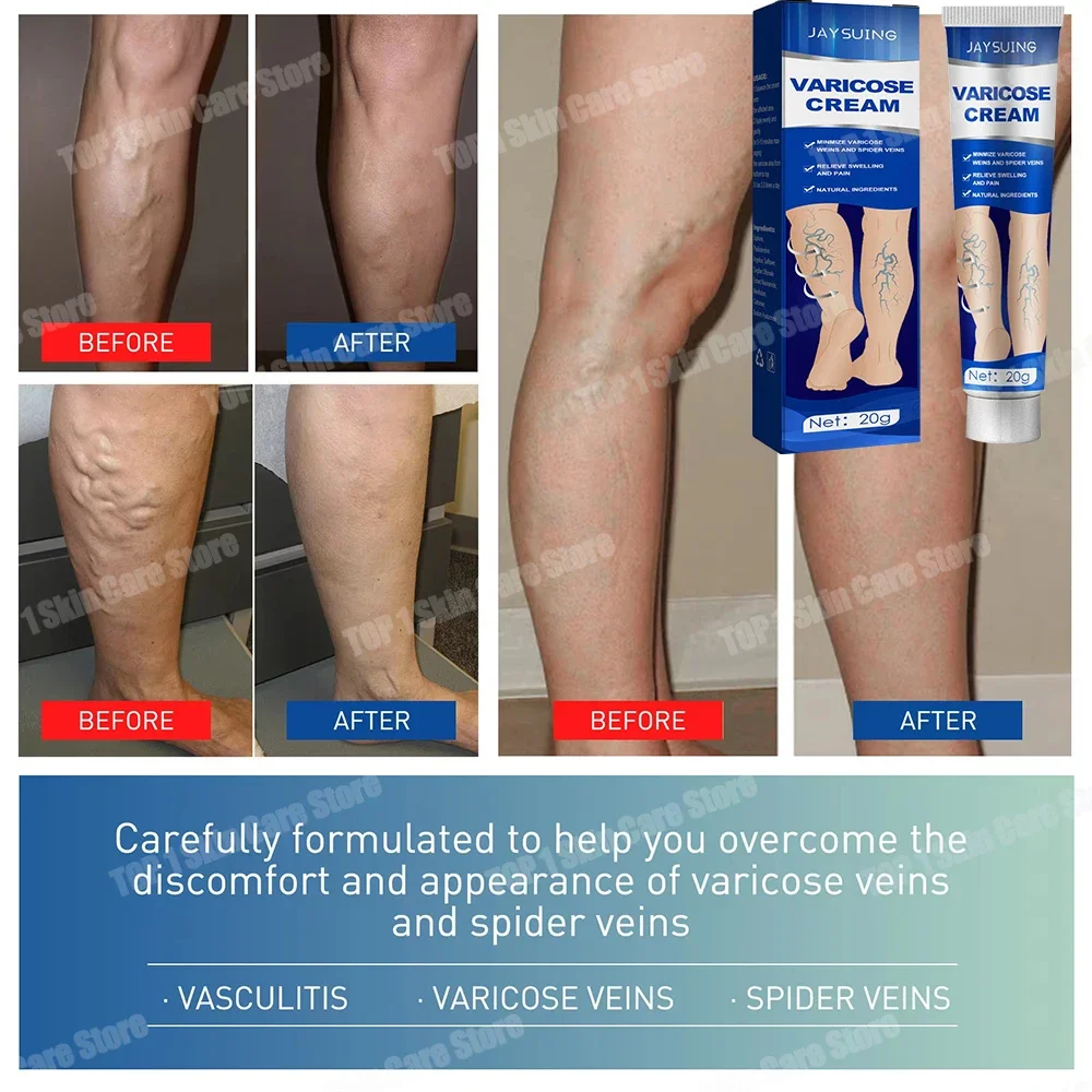 

Safe and effective varicose vein ointment effectively alleviates vasculitis, lower limb varicose vein excision cream