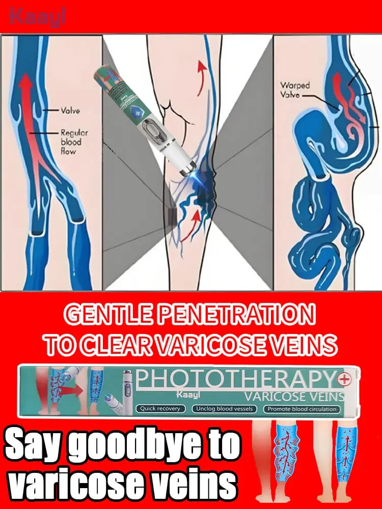 

Support Circulation for Vein Health, Strength, and Function | Reduces Spider Veins and Heaviness | Laser vein
