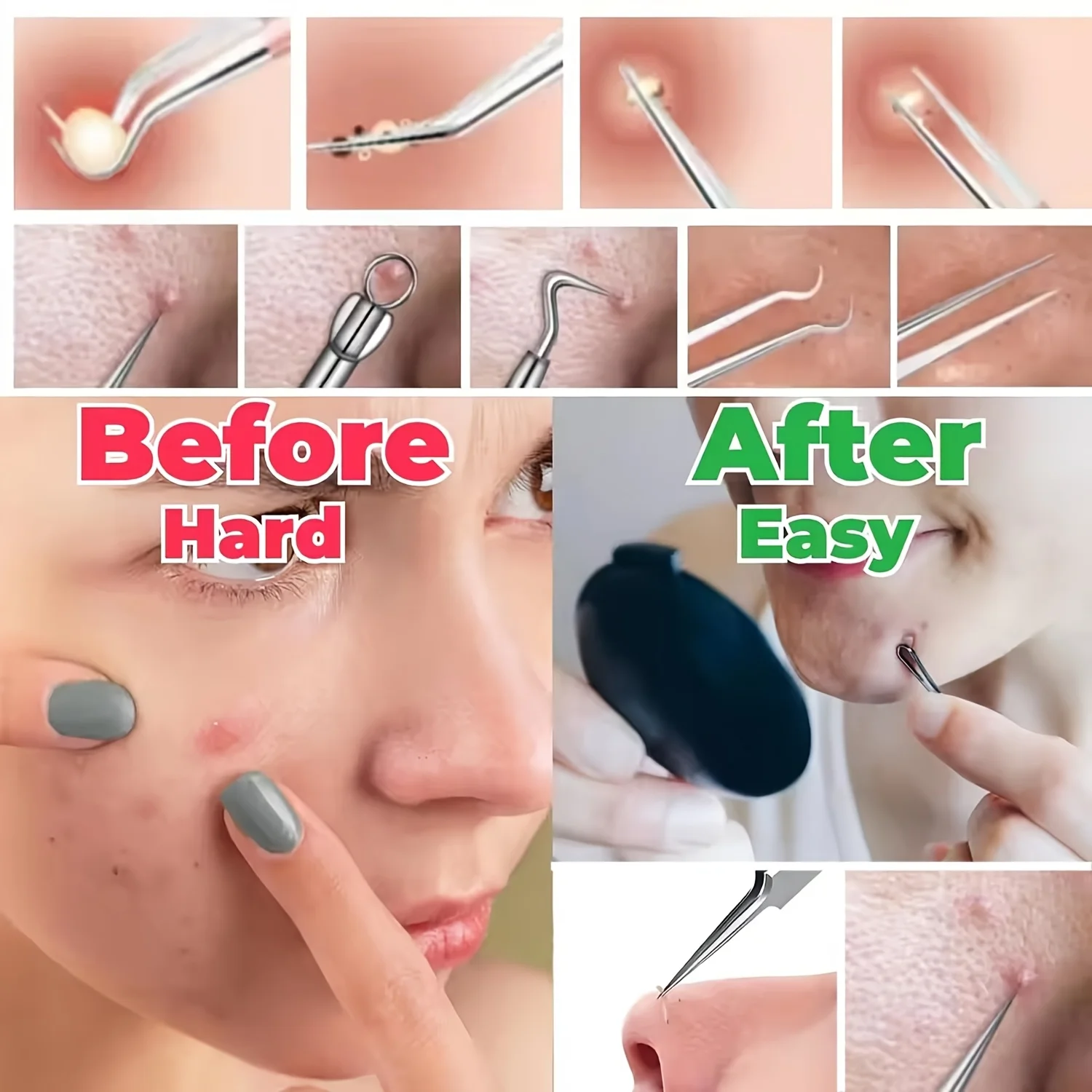 Mitesser-Entfernungsset aus Edelstahl – zum Entfernen von Mitessern, zur Entfernung von Akneextraktion, Gesichtspflegeset zur Entfernung von Nase und Gesichtsflecken