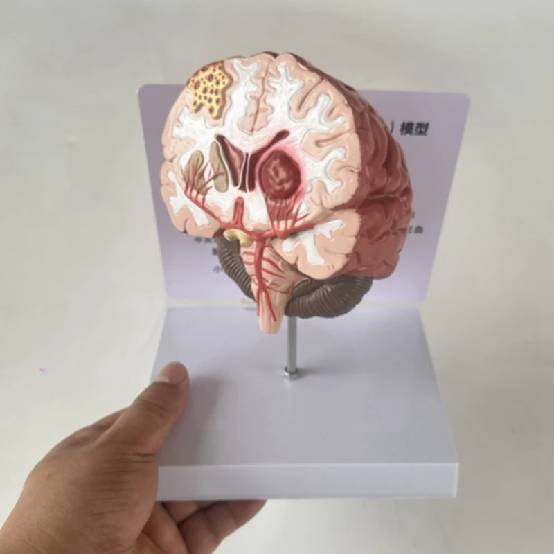 Top-Human Brain Disease Model - Brain Pathology Brainstem Hemorrhage  Teaching Model - Human Brain Anatomy Model