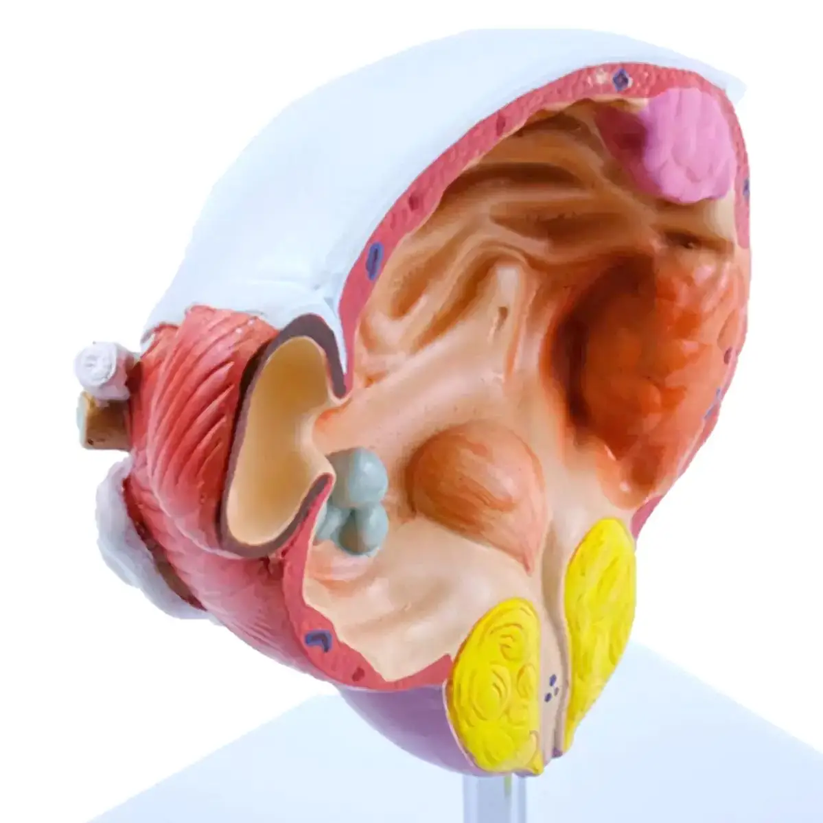 Human Bladder Enlarged Prostate Tumors Cystitis Model Medical Teaching Models