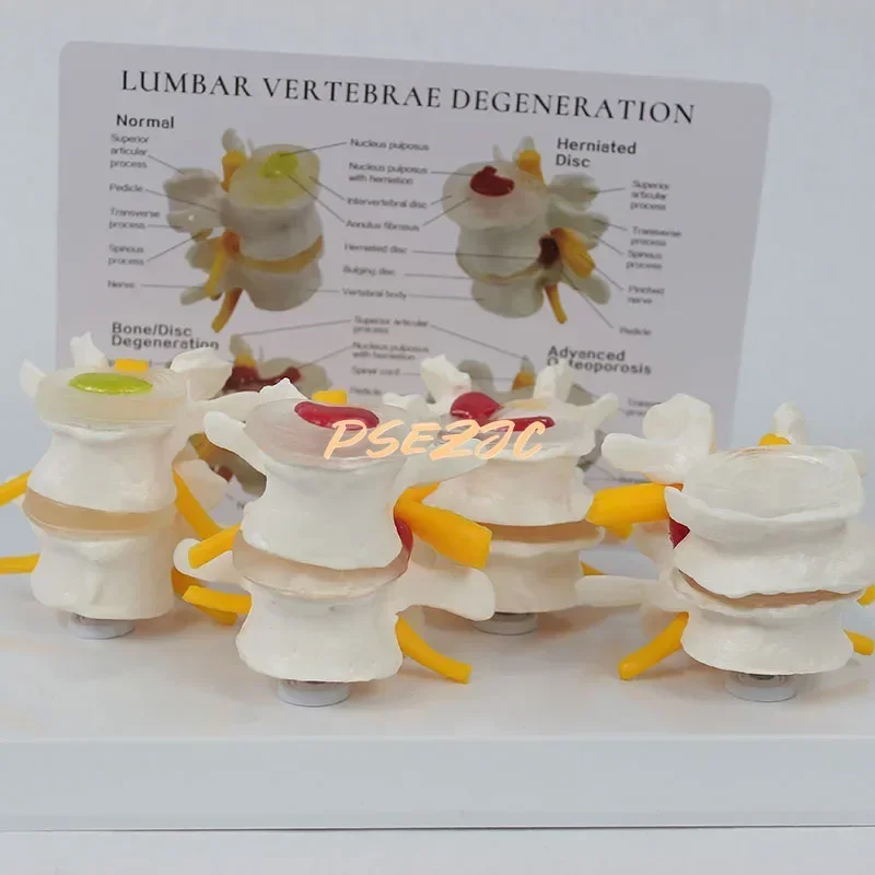 Stage 4 Pathology Lumbar Spine Human Model Orthopedic Teaching Demonstration Assisted Demonstration Teaching (with Back Card)