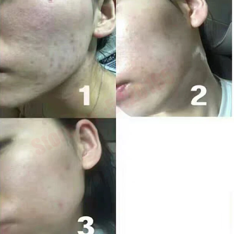 5 Vials 10ml Korean Hyaluronic Acid Ampoule Serum Facial Repair Essence For Moisturizing Anti-Aging Wrinkle Skin Care