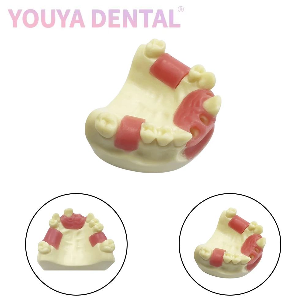 1Pcs Dental Implant Model Maxillary Missing Tooth Practice Model For Dentist Students Practical Training Demonstration Tool