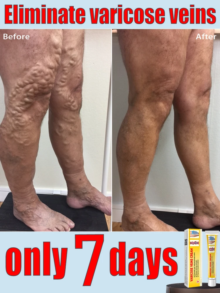 Varicose vein ointment, repair varicose veins and vasculitis