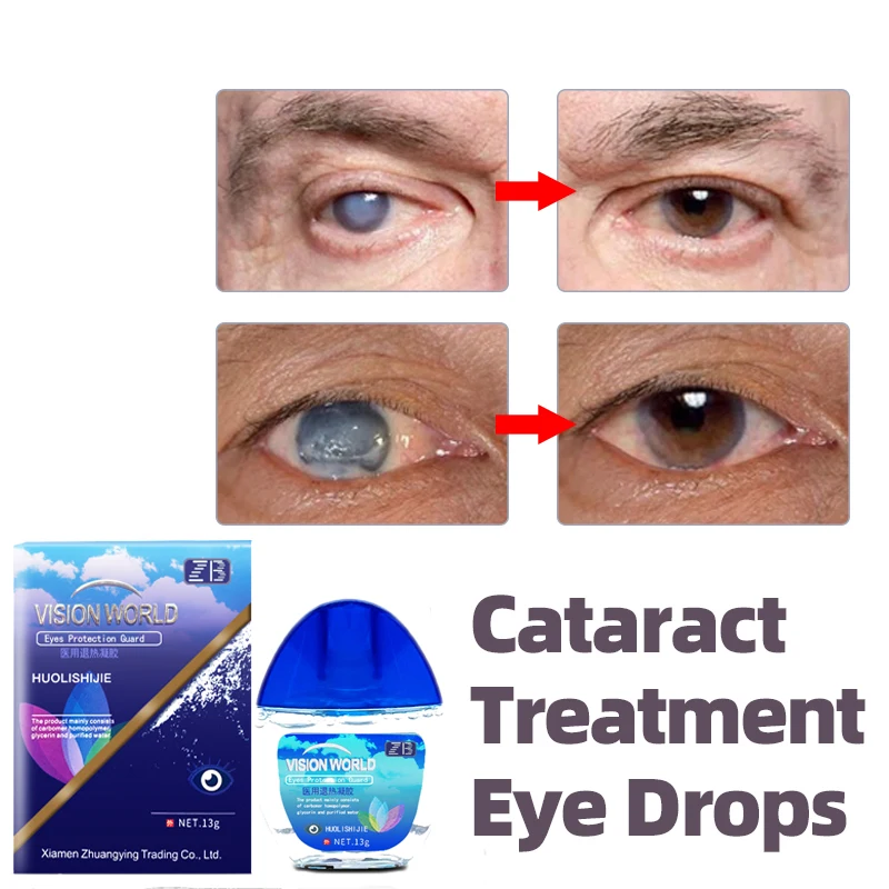 13g/pcs Eye drops for the treatment of cataracts, glaucoma, visual impairment, relief of blurred vision, eye care, and eye drops