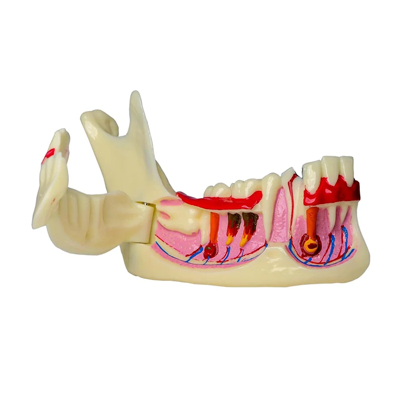 

Dental Endodontic Treatment Model Mandible Tissue Anatomical Model Dentistry Study Teaching Medical Teeth Model