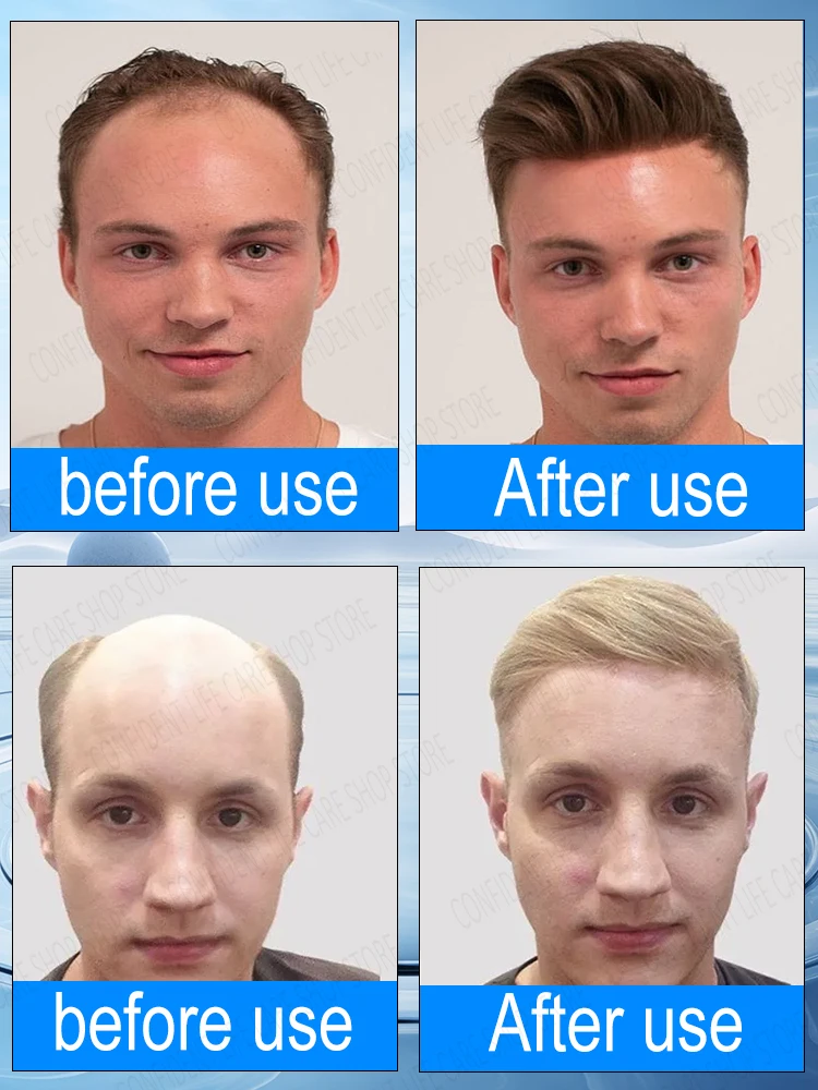 Say goodbye to baldness, hair volume increases dramatically in 3 days，The effect is comparable to hair ᴛʀᴀɴsᴘʟᴀɴᴛᴀᴛɪᴏɴ