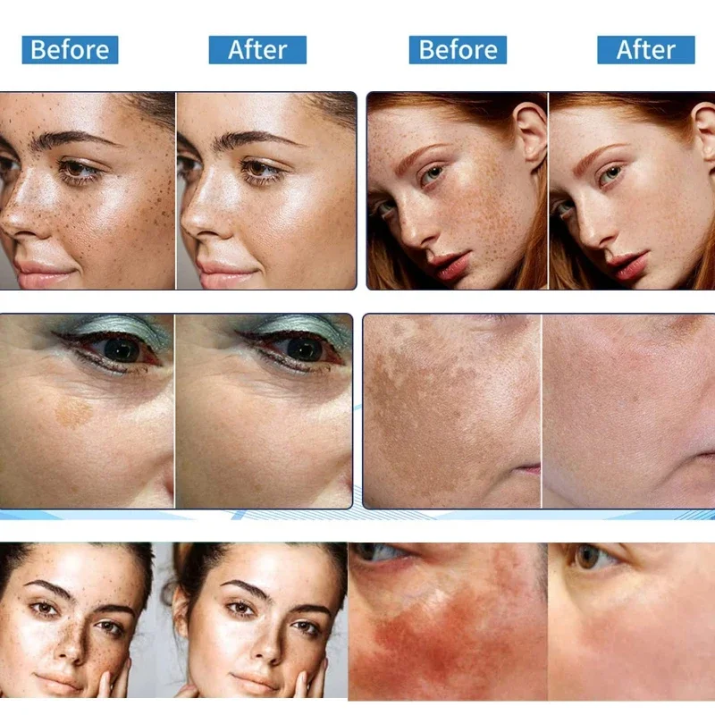 Freckles Removal Cream Remove Facial Spots Skin Dark Spot Remove Melasma Age Spots Sunspots Whitening And Freckle Removing Cream