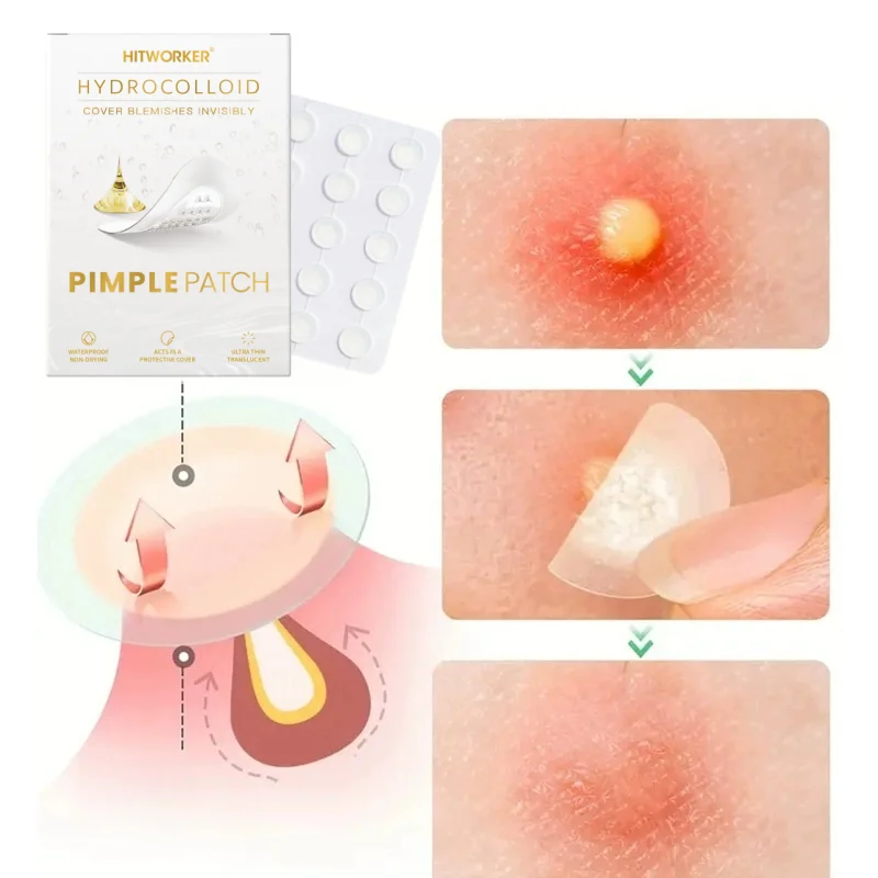 375pcs Hydrocolloid Acne Patches – Invisible Waterproof Spot Covers for All Skin Types, Day & Night Blemish Care