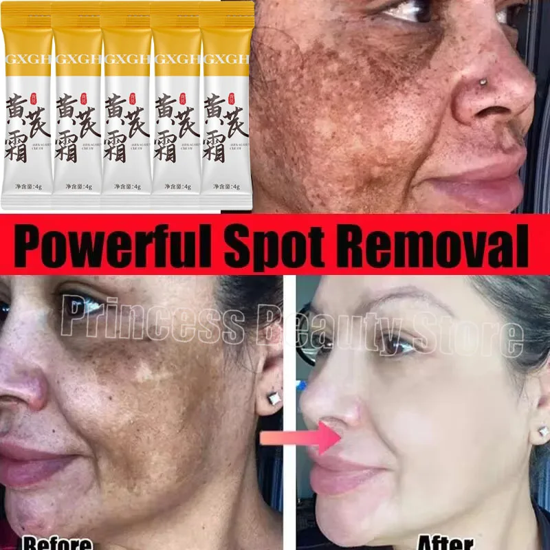 

Powerful Spot-removing Whiten Cream Brighten Skin Fast Eliminates Melanin Pigmentation Melasma Dark Spots Moisturize Beauty Gel