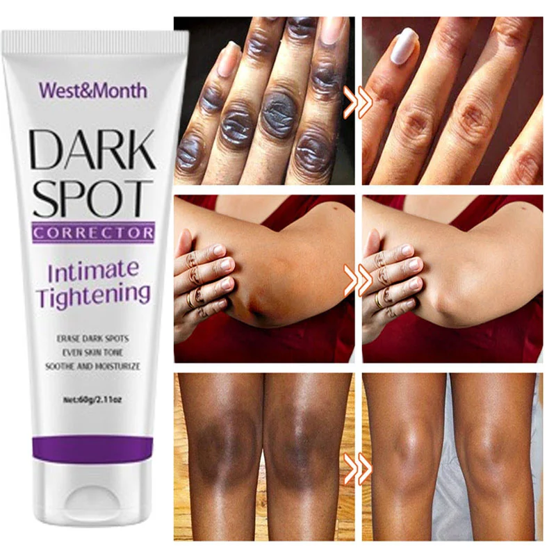 

Nicotinamide Brightening Cream For Dark Skin Effective Lighten Thigh Inner Bleach Remove Melanin Private Parts Brighten Cream