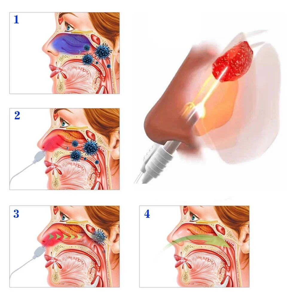 BioNase Nose Rhinitis Sinusitis Cure Therapy Nose Massage Hay Fever Low Frequency Pulse Laser Runny Sneeze Treatment Machine