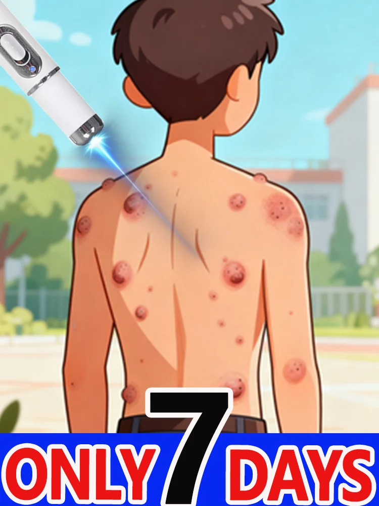 

Синий лазерный карандаш для решения проблем кожи и быстрого удаления папиллом.