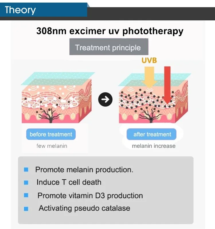 Лазер Excimer 308 нм, эффективное лечение кожи, лечение Vitiligo, ручная Лазерная лампа нм