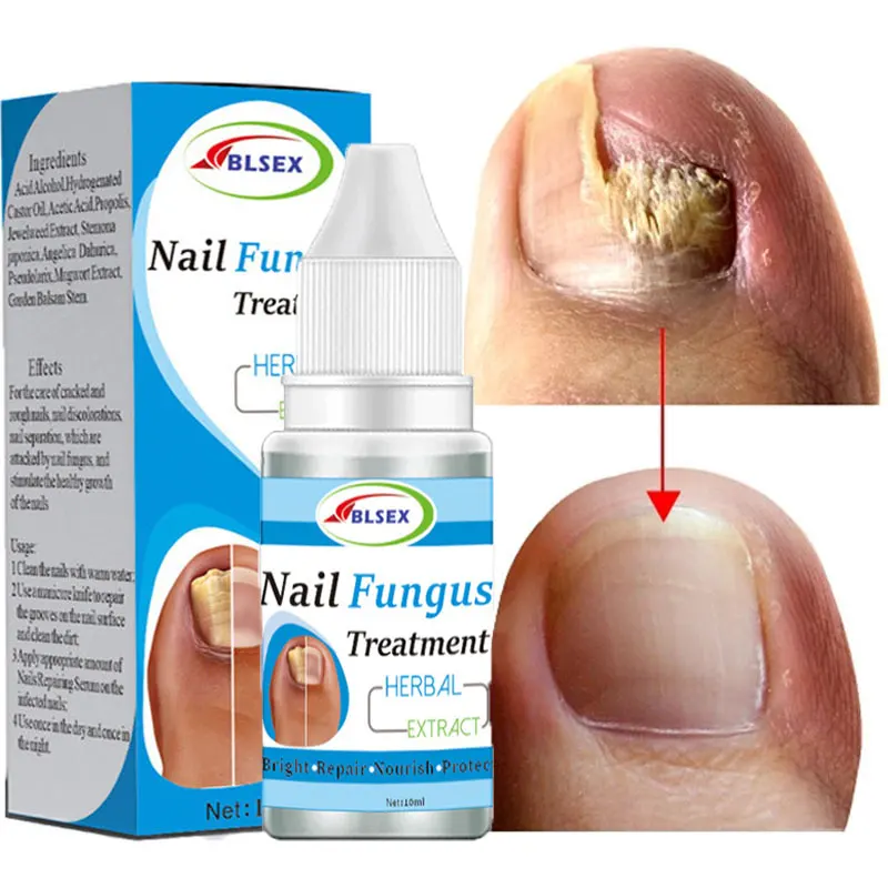 

Fungus Nails Treatment for Fingernails Toenails Repair Onychomycosis Paronychia Anti Infection Toe Nail Fungal Removal Liquid