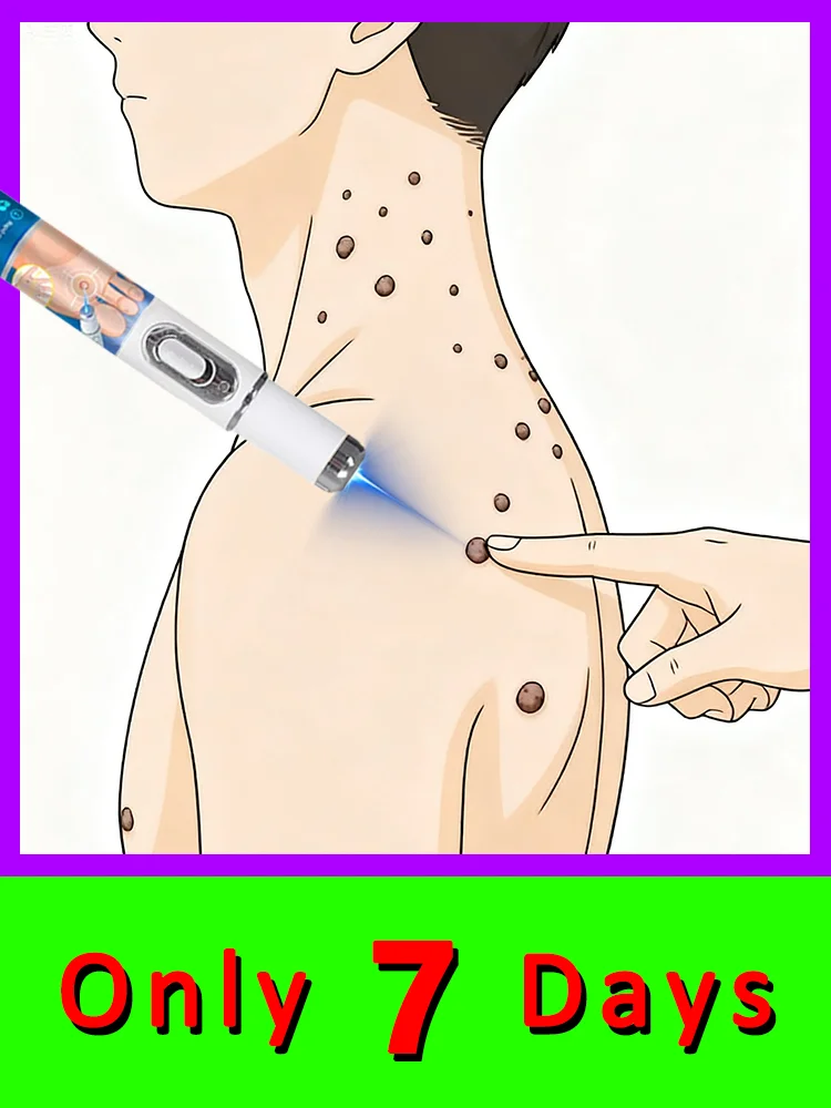 

blue light pen solve warts,2025 hot sale wart care tools,unisex,Free shipping