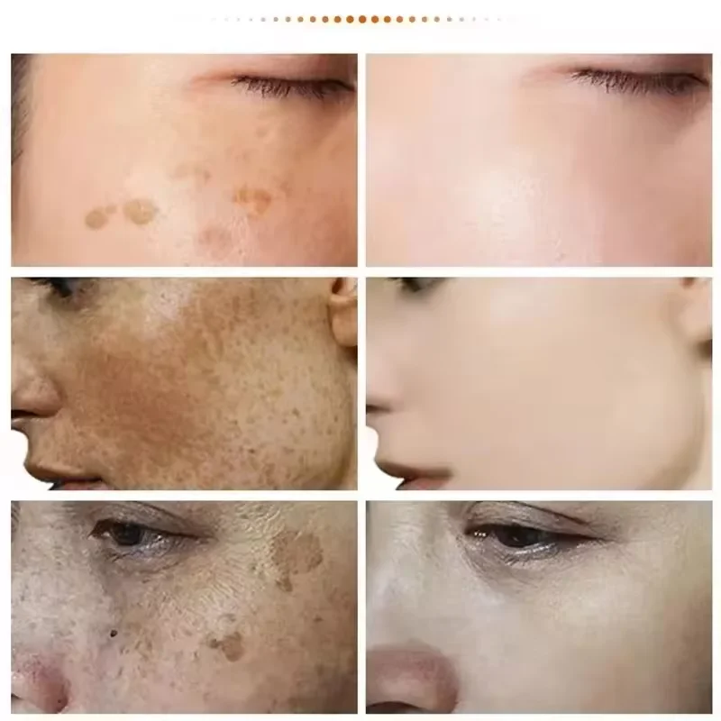 Potente crema sbiancante per la rimozione delle macchie Illumina la pelle Elimina rapidamente la pigmentazione della melanina Melasma Macchie scure