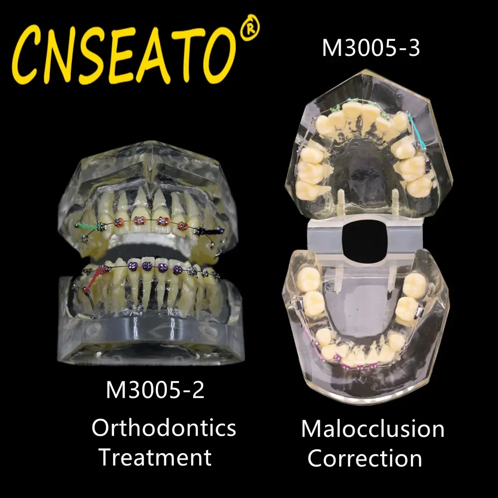 

Dental Orthodontics Treatment Model Malocclusion Correction Study Demonstration Teeth Model With Chain Bracket Dentistry Teach