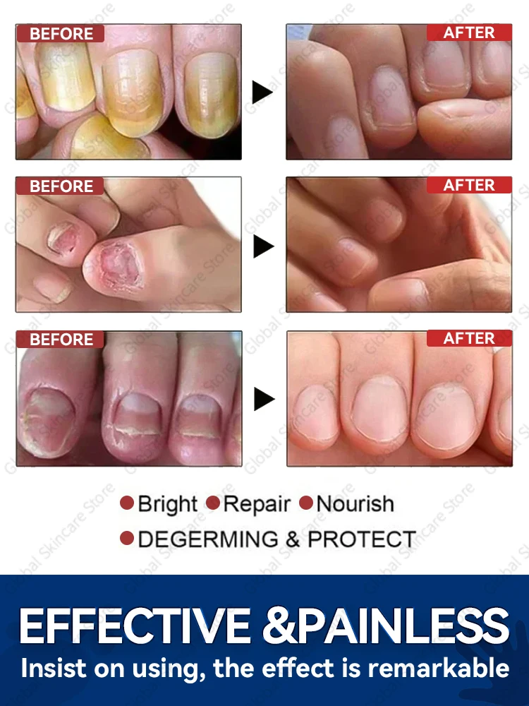 Problèmes d'ongles? Résolu en 7 jours!