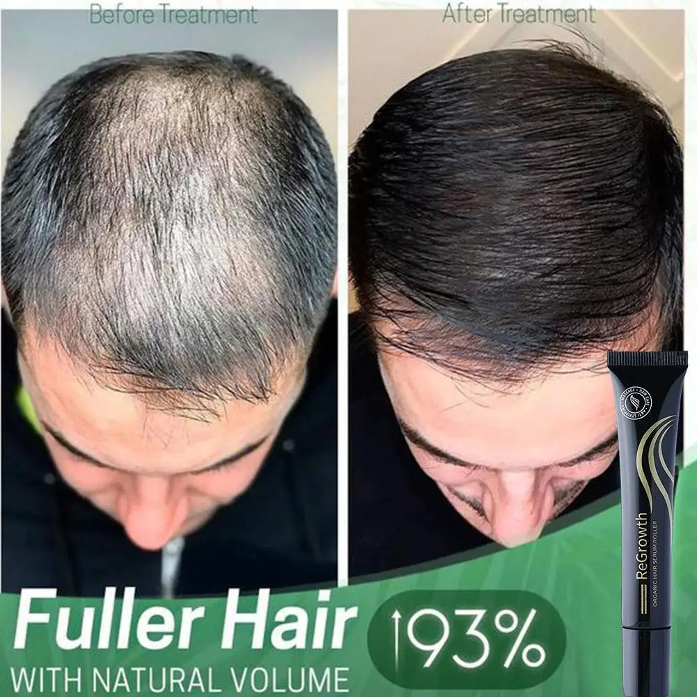 juego-de-rodillos-de-suero-para-el-cabello-organico-para-el-crecimiento-suero-de-biotina-esencia-masajeadora-roll-on-triple