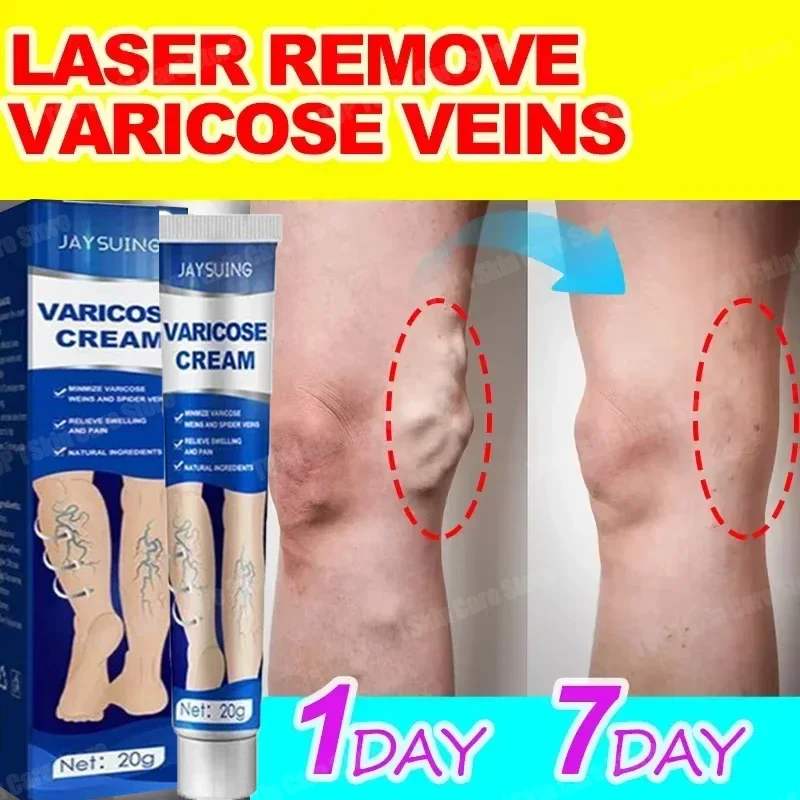 Varicose Vein Removal Cream Spider Vein Pain Varicose Vein Effective Vasculitis Cream Soothes Veins Smooth Healthy Skin 20g