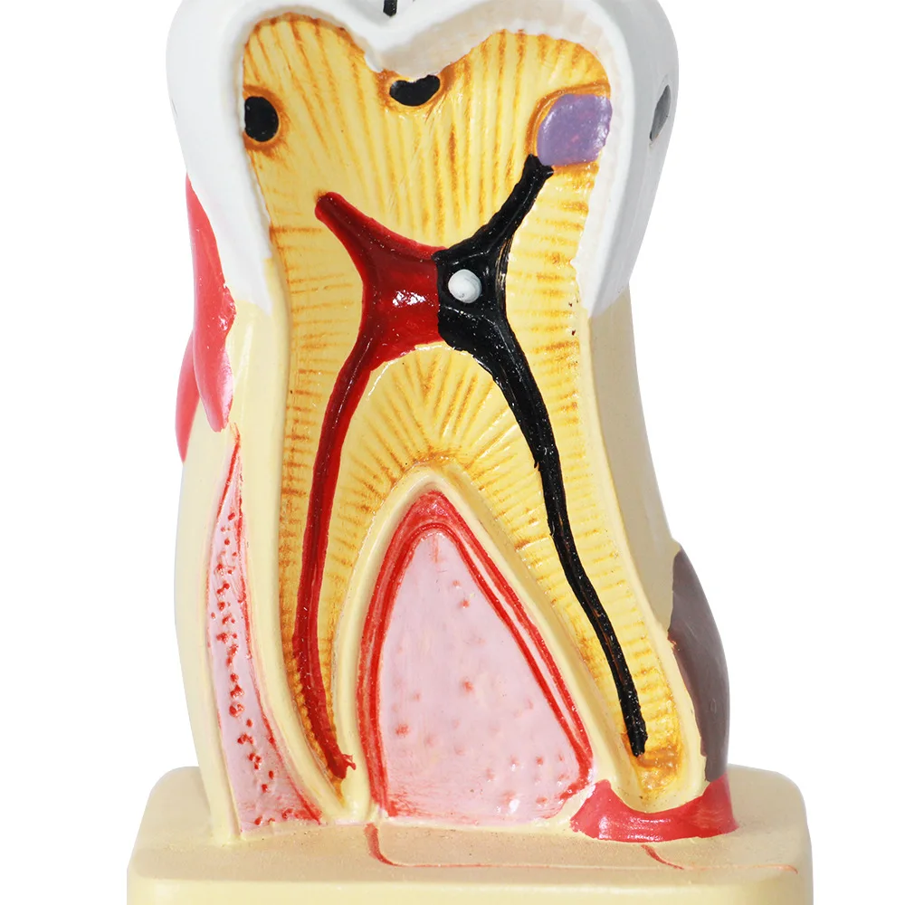 Human dental model, oral care and health model, dental caries anatomical model