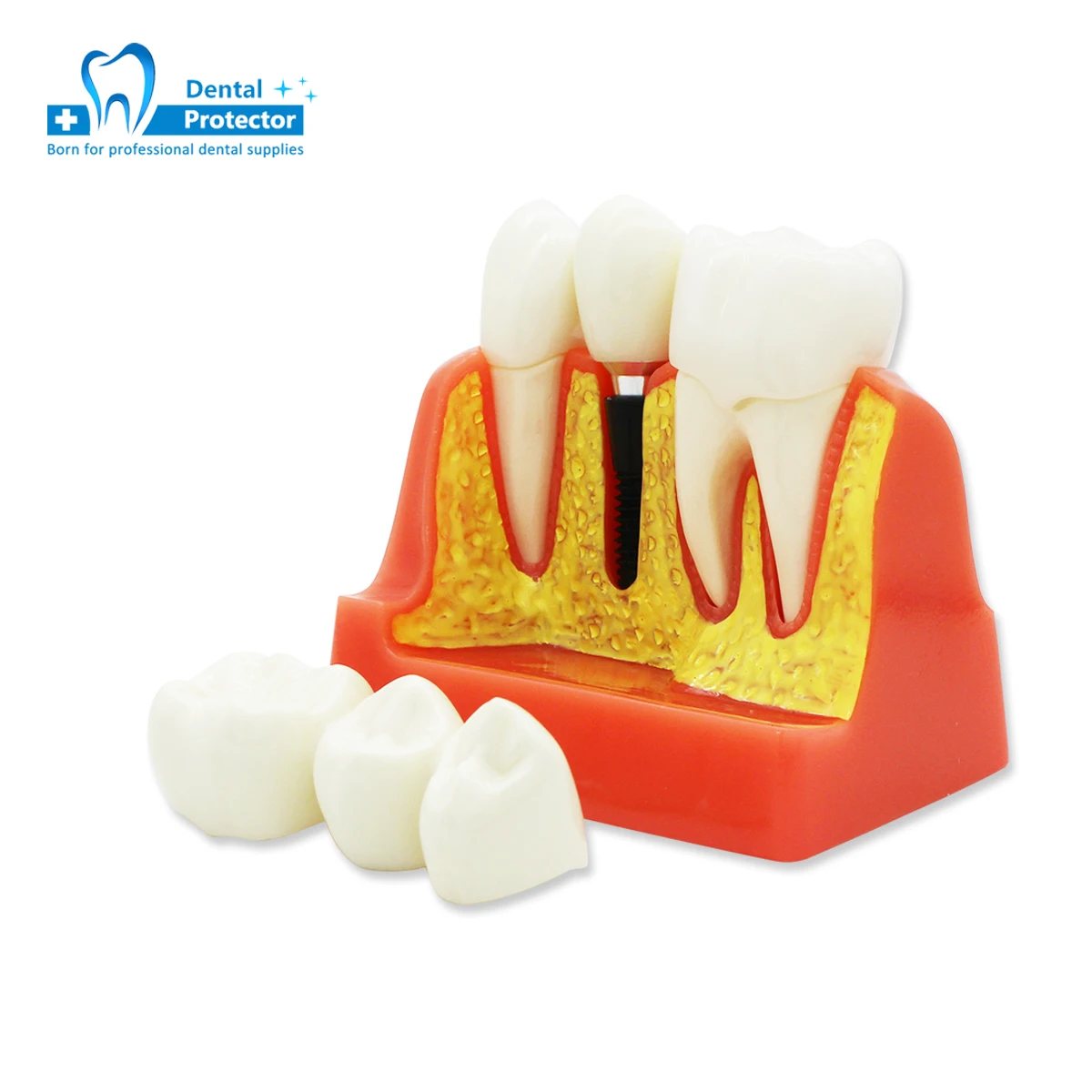 

Dental Implant Teach Crown Bridge Removable Model Porcelain Teeth Model Dental Demonstration Model for Dentist Teaching