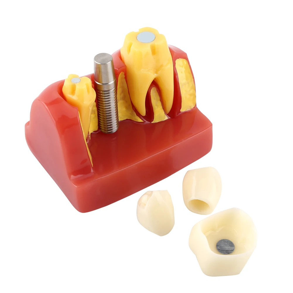 1Pcs Resin Dental Student Demonstration Tooth Model Implant Analysis Crown Bridge For Dentist Oral Medical Product Equipment