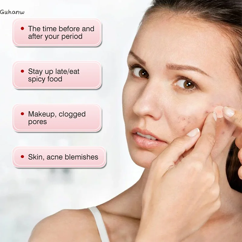 

【WHB】MOIKA Pimple Patch Acne Invisible Acne Removal Skin Care Stickers Concealer Face Spot Beauty Makeup Tools