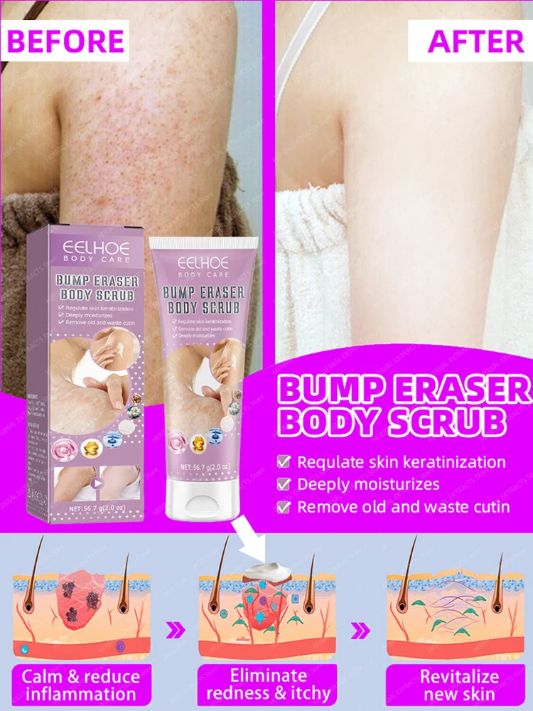 Keratosis Pilaris Cream  Rough Goosebumps Tiny Bumps Red Bumpy Chicken Skin Removal