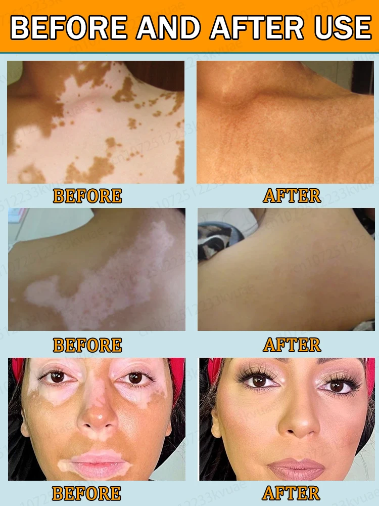 Tratamento a laser para vitiligo. Remova rapidamente vitiligo e manchas brancas