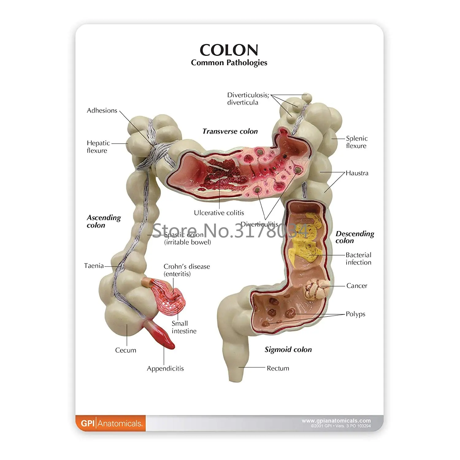 Colon Model Human Body Anatomy Replica of Colon w/Common Pathologies for Doctors Office Educational Tool