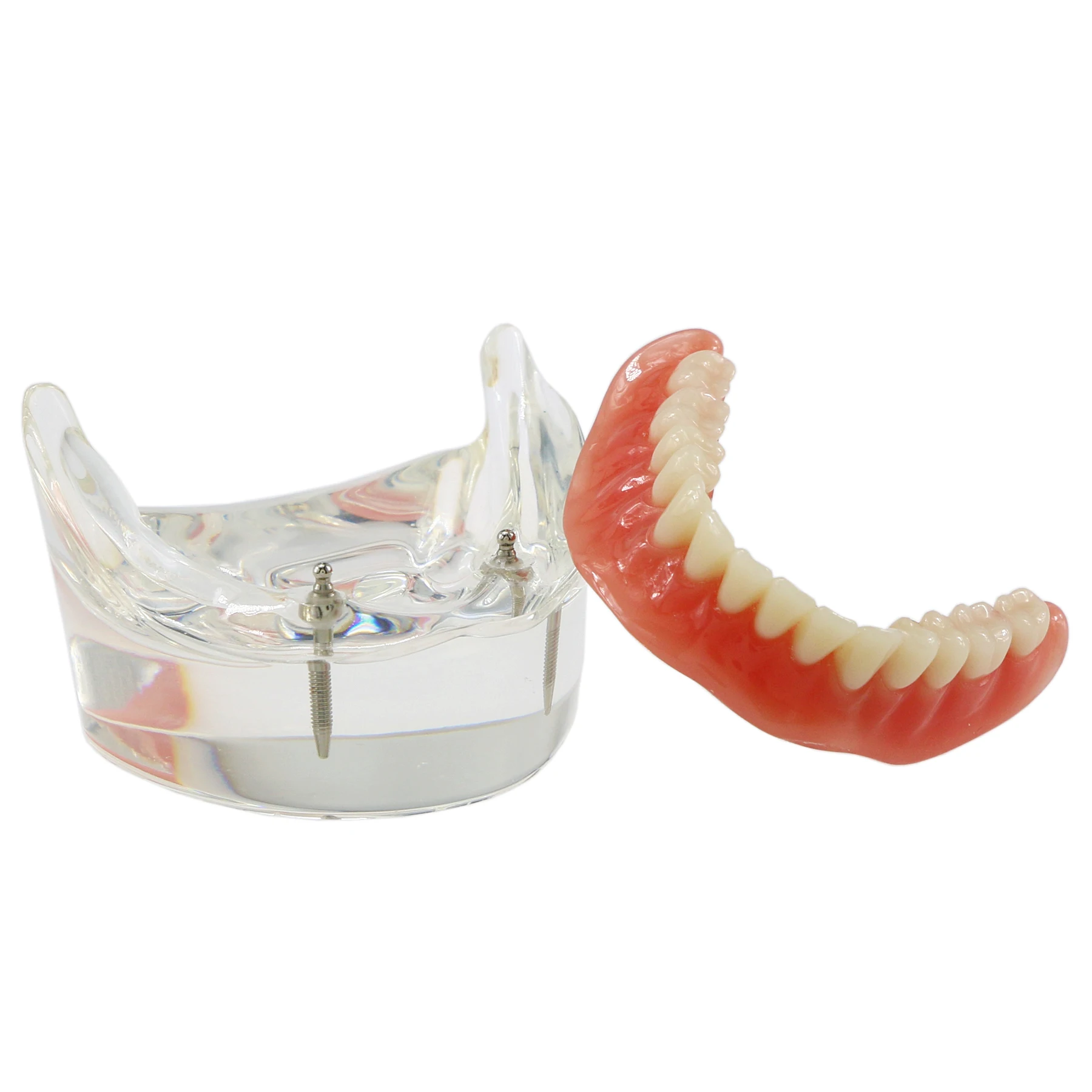 Dental Lower Jaw Implant Restoration Model With 2 Implants Removable Overdenture Teeth Model For Dentist Teaching Training Demo