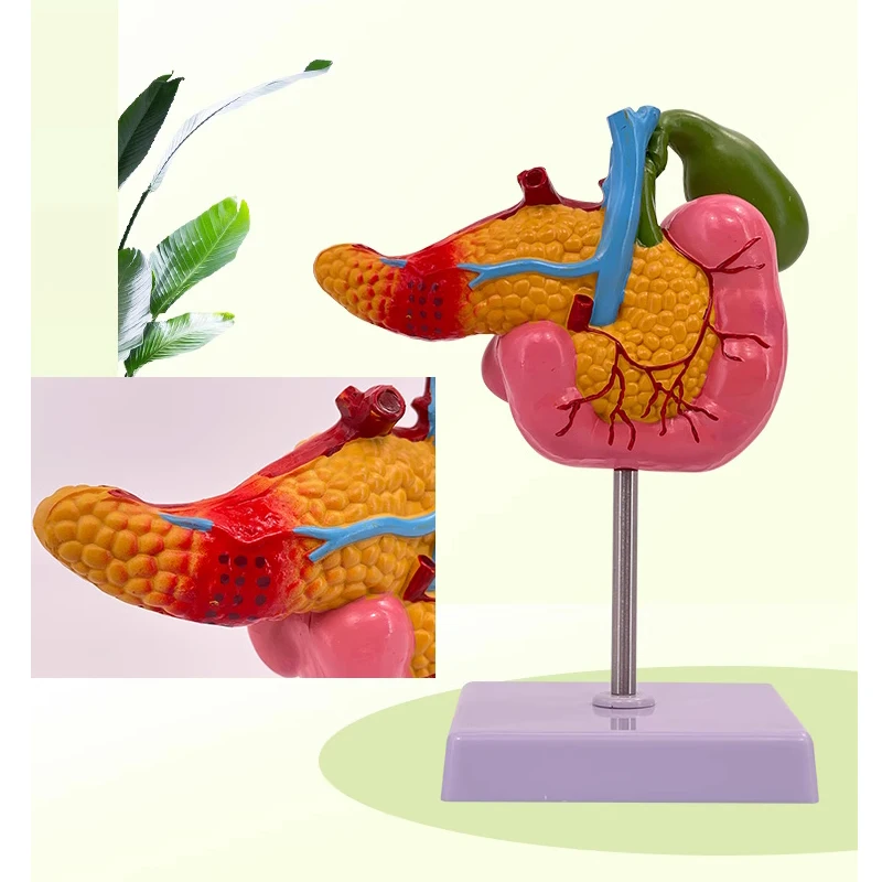 Medical pathological model of pancreas, duodenum and gallbladder hepatobiliary model of cholelithiasis surgical system