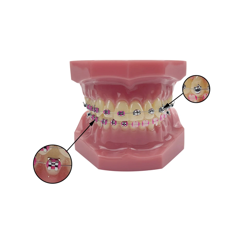 Dental Spherical Self-Ligating Bracket Orthodontic Tooth Model Half Metal Half Ceramic Braces Comparison Model Dentist Teaching