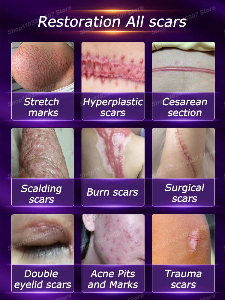 Laser therapy Keloid scar