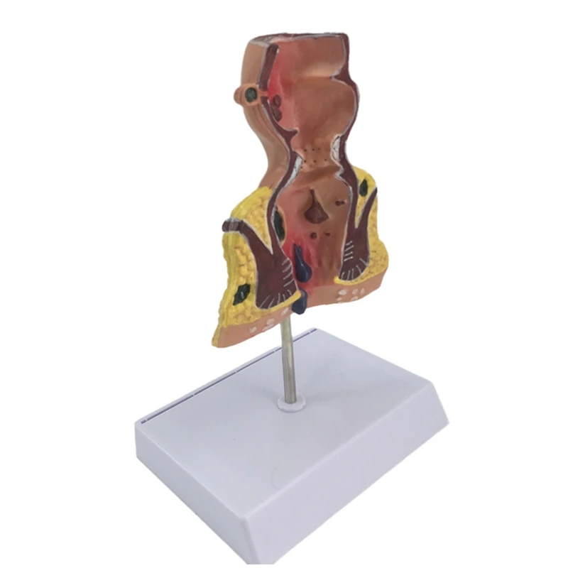 

Human Rectum Model With Common Pathologies,Replica For Anatomy And Physiology Education,'s Office Anatomical Model